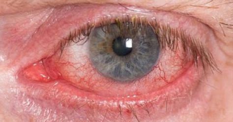 Remedios caseros para la rosácea ocular | Ojos rojos remedio ...