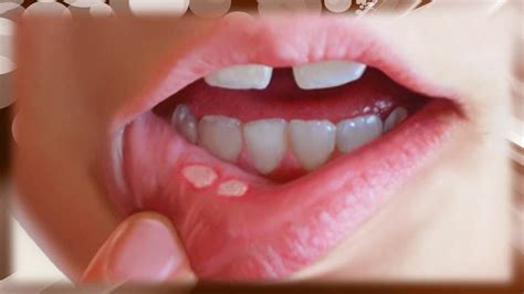 Remedios caseros para las llagas en la boca   Tratamiento natural para ...