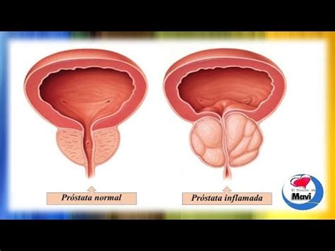 Remedios Naturales Para La Próstata Inflamada