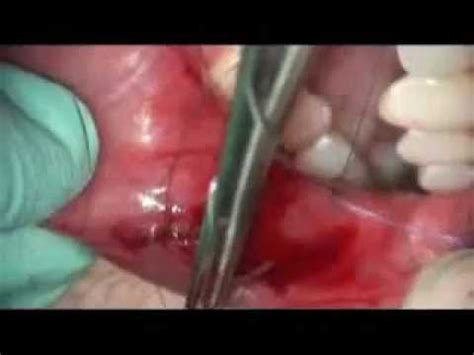 Removal of Traumatic Fibroma from Lower Lip by Cherry Hill ...