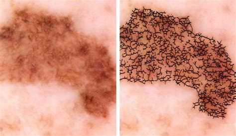 Researchers develop automated melanoma detector for skin ...
