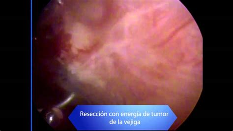Resección de tumor maligno de la vejiga endoscópica   YouTube