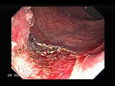Resección Endoscópica de Tumor Rectal   YouTube