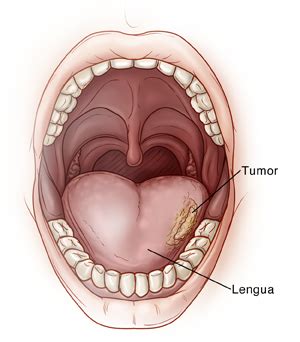 Resection, Transoral, for Oral Cancer