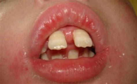 Respiración Bucal   DentalKids Odontopediatría