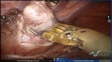 Ressecção robótica de tumor de esôfago torácico   YouTube