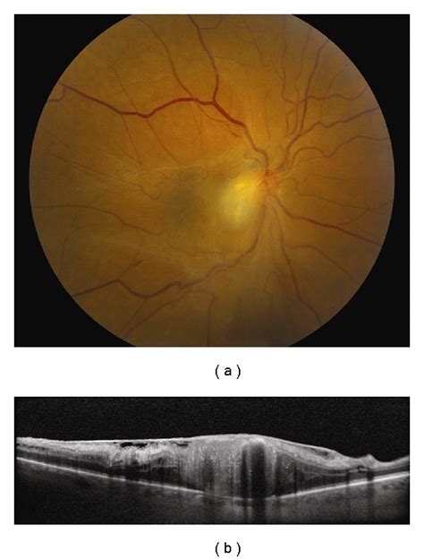 Retinal astrocytic hamartoma.  a  Juxtapapillary retinal astrocytic...