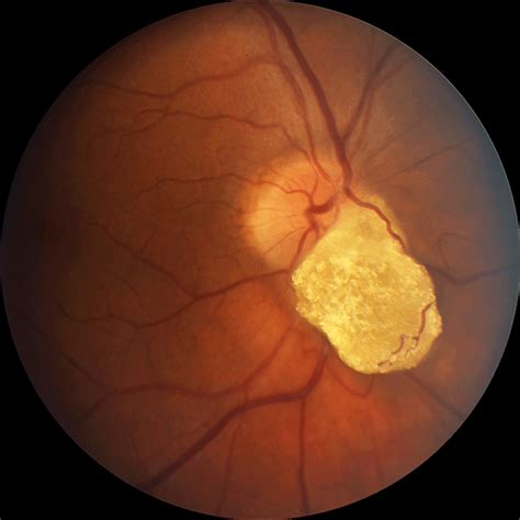 Retinal Astrocytic Hamartoma – Webvision