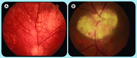 Retinal astrocytic hamartomas.  A  Small noncalcified astrocytic ...