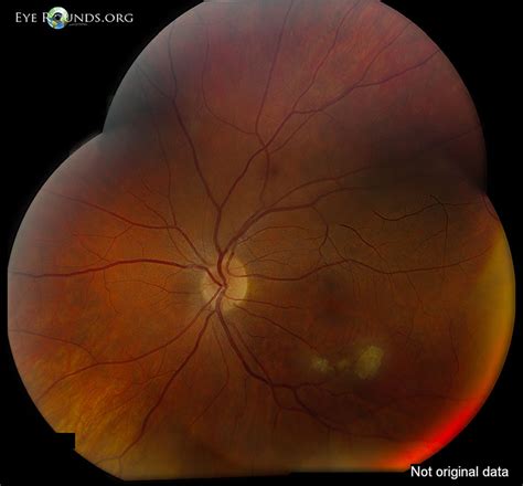 Retinal astrocytic hamartomas