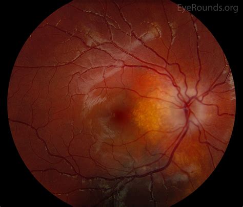 Retinal astrocytic hamartomas