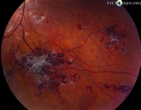 Retinal Cavernous Hemangiomas: The University of Iowa, Ophthalmology