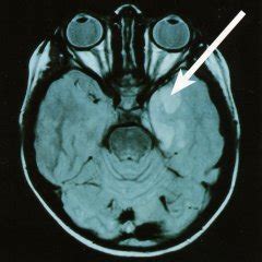 RMT Imagen, tumor cerebral. diagnostico de epilepsia