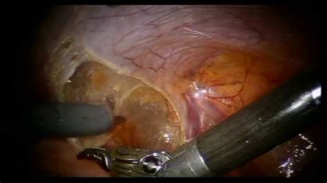Robotic prostatectomy   Dropping the bladder   YouTube