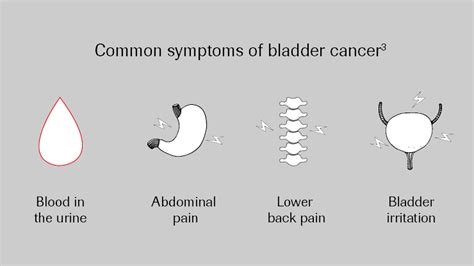Roche   About bladder cancer