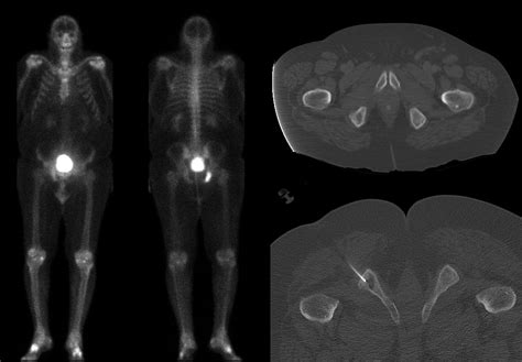 Roentgen Ray Reader: Osteolytic Lesions in Prostate Cancer