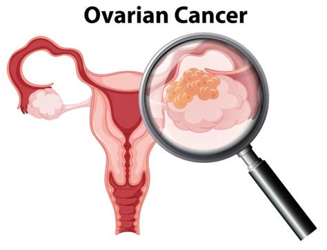 Royalty Free Ovarian Cancer Clip Art, Vector Images ...