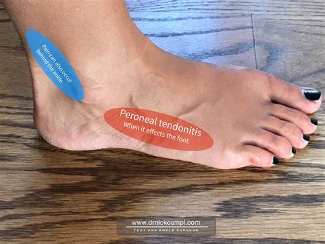 Running Injuries: Foot pain on the “outside” of your foot ...