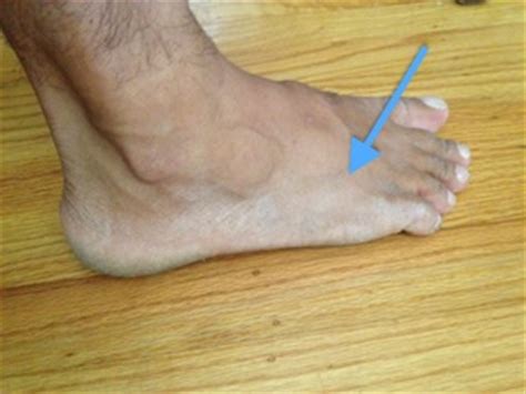 Running Injury   Top of the Foot and Ankle Pain ...