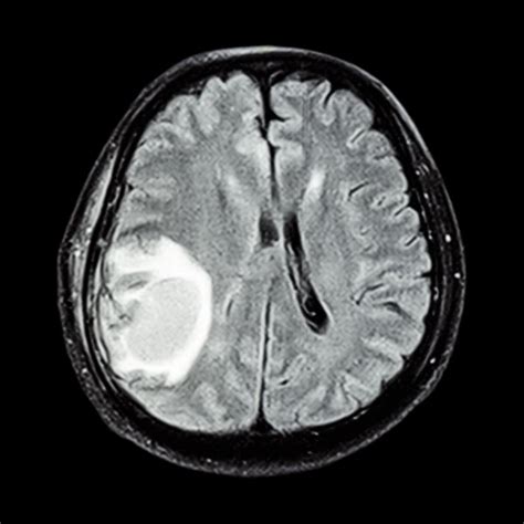 ᐈ Tumor cerebral fotos de stock, imágenes tumor cerebral ...