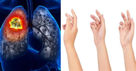 ¿Sabías que la posición de los dedos podría detectar el cáncer de pulmón?