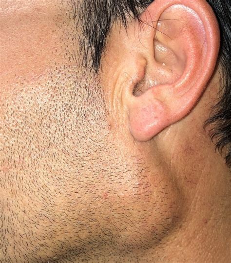 ¿Sabías que un bulto delante de tu oreja podría ser un tumor de ...