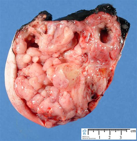 sacrococcygeal teratoma   Humpath.com   Human pathology