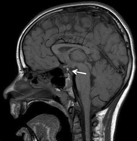Sagittal MRI scan of the patient with SOX3 duplication ...