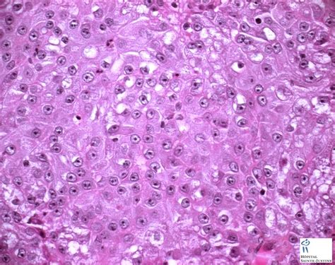 salivary mucoepidermoid carcinoma   Humpath.com   Human pathology