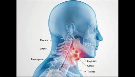 Salud: Síntomas iniciales del cáncer de garganta ¡Ten ...