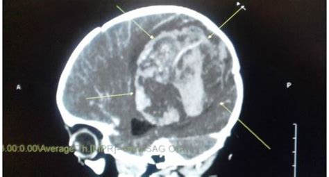 Salud: Tumor cerebral: conoce sus causas y cómo detectarlo ...