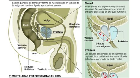 salud | tumores masculinos Cáncer de próstata: El más ...