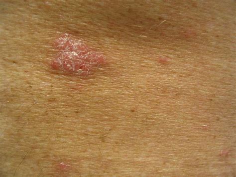 SCC Images – Non Melanoma Skin Cancers