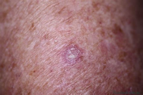 SCC  Squamous Cell Carcinoma    South East Skin Clinic