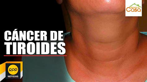 ¿Se puede vivir sin tiroides?   YouTube