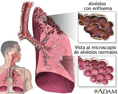 Semiología Quirúrgica: Patologías Pulmonares