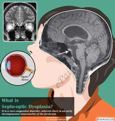 Septo optic dysplasia awareness   silver ribbons | Close ...