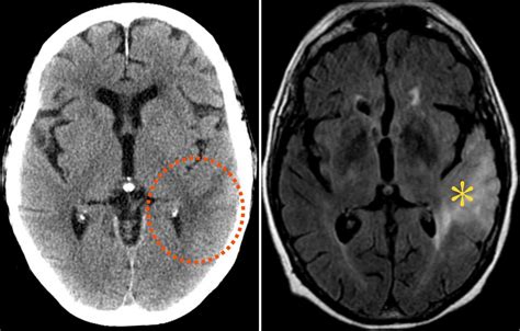 serba 3.blogspot.com: Brain Tumors and how treatment
