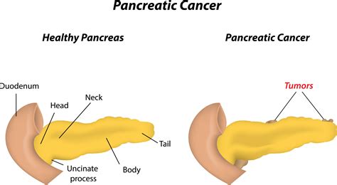 Shape Shifting Pancreas Cells Set Stage for Development of ...
