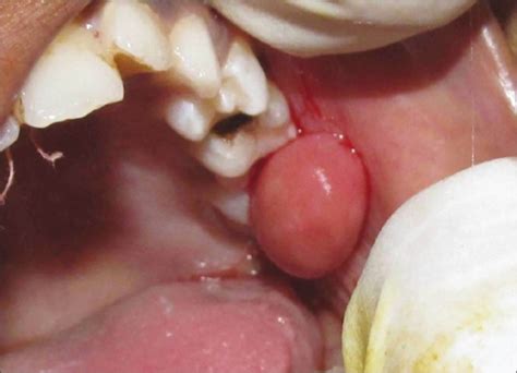 Showing fibrolipoma of left buccal mucosa