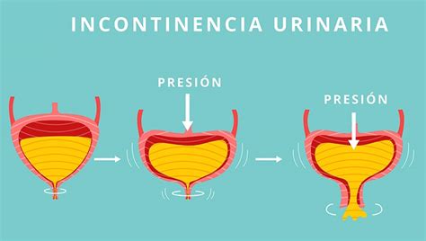 Si sufres de incontinencia urinaria estas son 6 maneras de ...