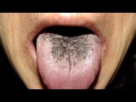 Si tienes tu lengua como estas, corre al medico esto es ...