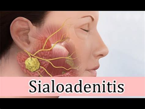 Sialoadenitis inflamación sublingual, granos rojos ...