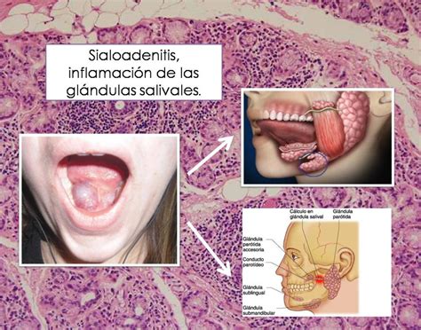 Sialoadenitis, una inflamación de las glándulas salivales.   Clinica ...