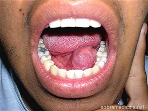 Sialoadenitis, una inflamación de las glándulas salivales