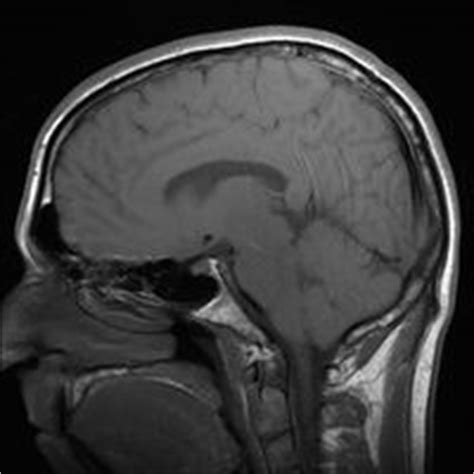 Signos y síntomas de un tumor cerebral Tálamo / Lowstars.com