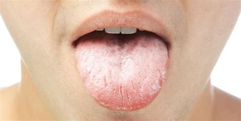 Signos y síntomas del cáncer de boca   Autoridad Consejo