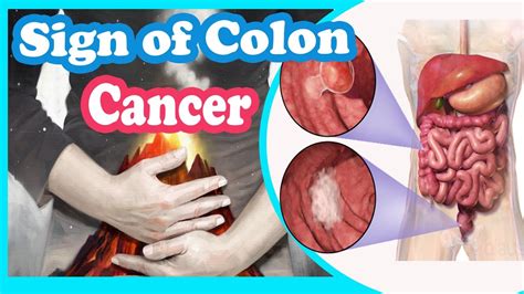 Signs And Symptoms of Colon Cancer You Should Not Ignore ...