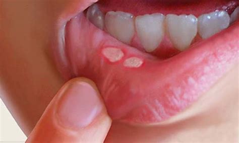 Signs and symptoms of mouth cancer Are You Mouth Aware?