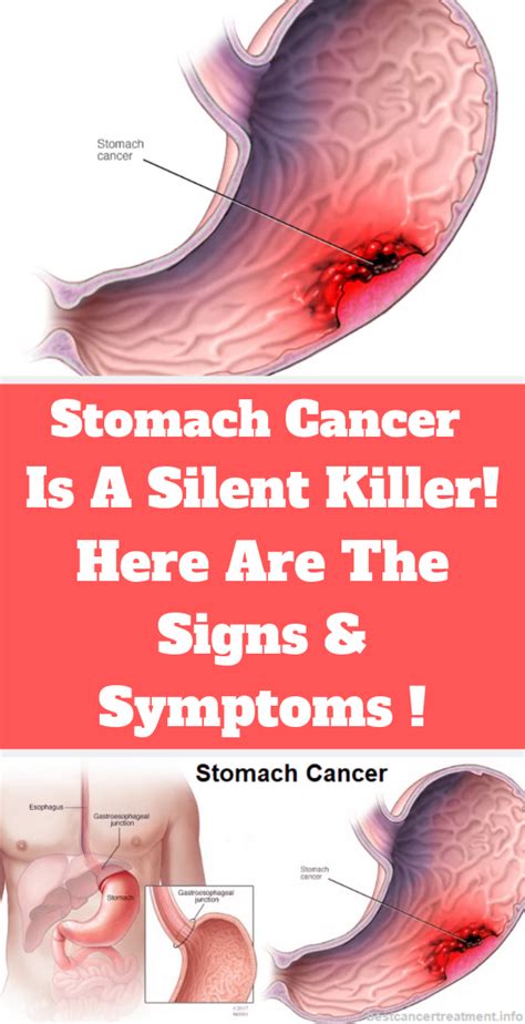 Signs And Symptoms of Stomach Cancer !   Ideas To Try
